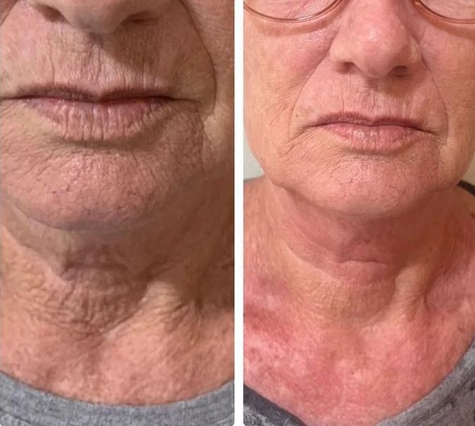 Resultado antes e depois 1